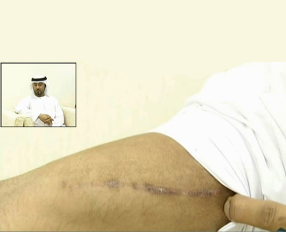 إماراتي يحقن نفسه بالسيلكون للحصول على جسد مثالي